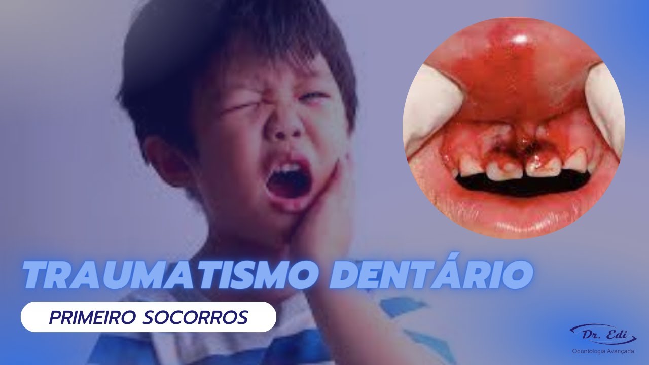 Tipos De Traumatismo Dentários E Seus Tratamentos - YouTube