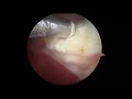 arthroscopic lateral release of the knee cap