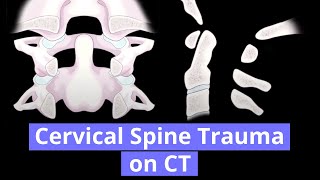 Cervical Spine Trauma on CT