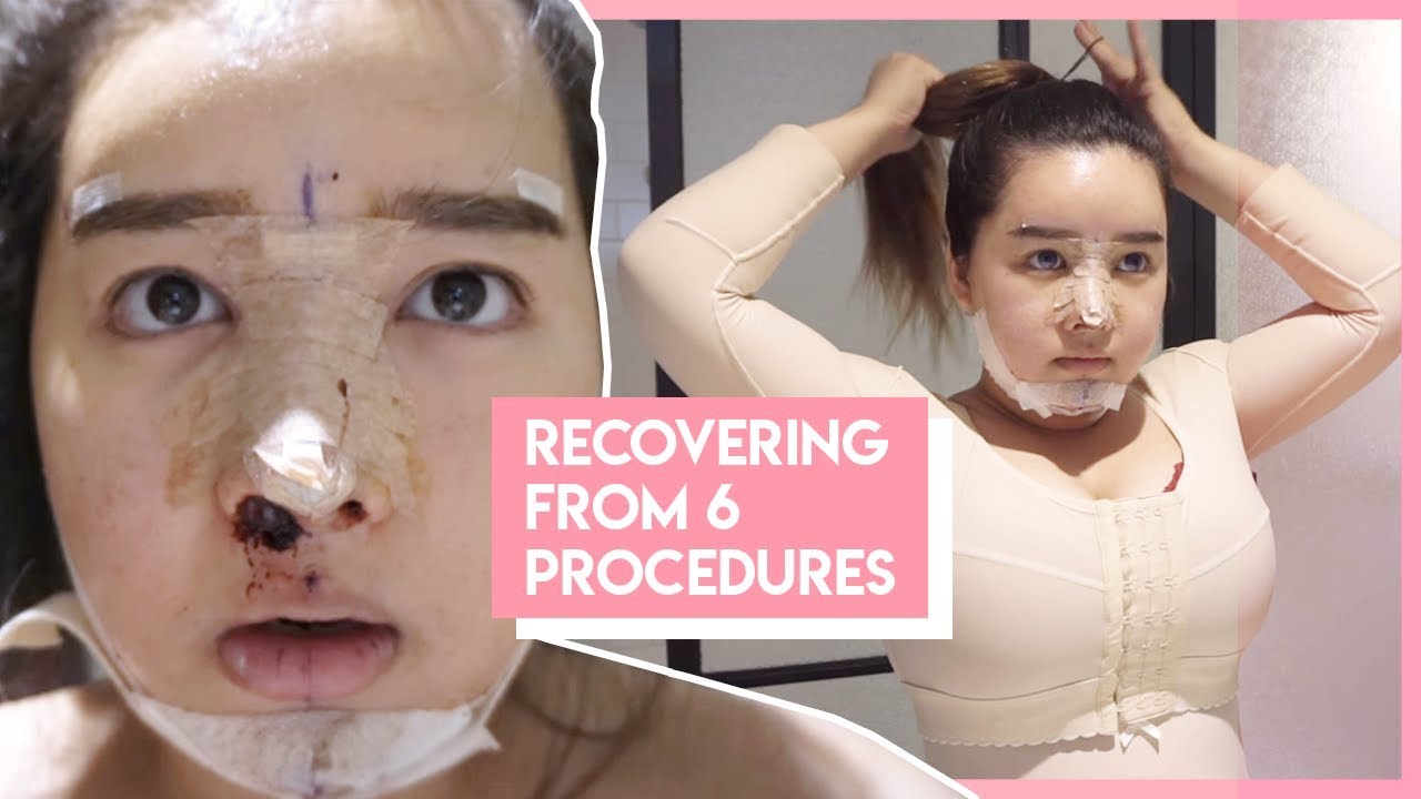 Korean Plastic Surgery Recovery Journey | Nose Job, Chin Implant ...