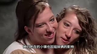 美国“双头姐妹”之一已婚，姐妹“共享”一个身体，怎么结婚生子