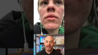 These accutane results were amazing!! #dermreacts #doctorreacts #accutane