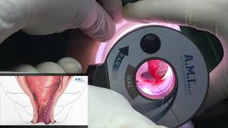 Hemorrhoidal Artery Ligation with Recto-anal Repair (HAL-RAR) using the AMI HAL Doppler II System