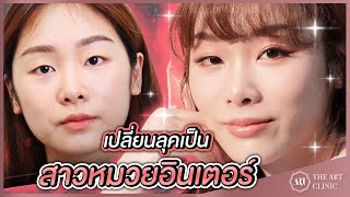 VLOG ตา 2 ชั้น : หมดปัญหาชั้นตาไม่เท่ากัน แก้ไขยังไงต้องดู The Art Clinic