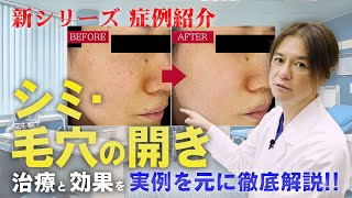 【新シリーズ】実際の症例をもとにシミ・毛穴の開きの治療について徹底解説！レーザーフェイシャル！POTENZA(ポテンツァ)！その効果は！？【症例紹介】