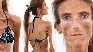 World's Skinniest Woman (Update), Valeria Levitin,  Anorexia, Diet, Eating Disorders