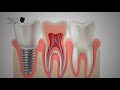 Titanium Dental Implants | Implants Pro Center© | San Francisco