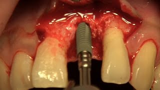 NR Line implantation on Ant. region - staged approach -