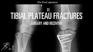 What does surgery and rehab of a tibial plateau fracture entail?