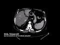 DEB-TACE: Chemoembolization for a 8 cm Hepatocarcinoma nodule