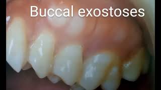 Buccal exostoses