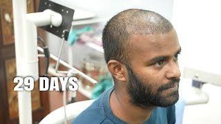 Hair Transplant | 29 Days Post Surgery | Shedding Phase | Donor Area Heal