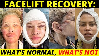Facelift recovery day by day: What's normal, what's not!