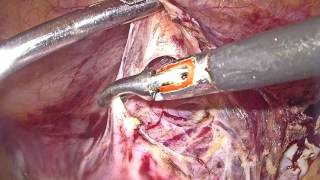 Total Laparoscopic Hysterectomy