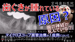 歯ぐきが腫れている。原因は神経が死んでいる？マイクロスコープ根管治療