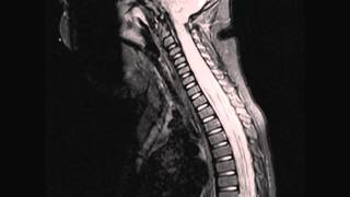 Transverse Myelitis