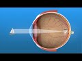 nearsightedness myopia