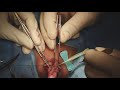 hypospadias decision making distal proximal hypospadias repair