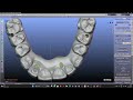 i bar designing for upper all on 4 smu implant in blender best laser teeth in 5days chennai india