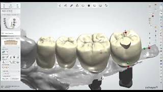 [SNUC] 3Shape을 이용한 Implant cement-less Crown Design