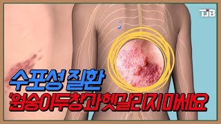 [닥터 리포트] 수포성 질환..'원숭이두창'과 헷갈리지 마세요｜ TJB 대전·세종·충남뉴스