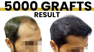 Grade 6 Baldness | 5000 Grafts Hair Transplant Result | Hair Transplant Mumbai |