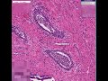 histopathology prostate acute prostatitis