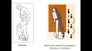 Fauchage et Steppage - Neurologie