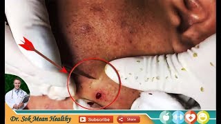 How To Removal Blackheads, The first By Dr. Sok Mean Healthy ( Part 18)