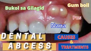 TYPES OF DENTAL ABCESS | NANA/BUKOL SA GILAGID | TREATMENT