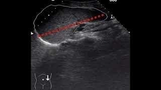 BAZO CRECIDO HIPERESPLENISMO CAUSAS SÍNTOMAS Y TRATAMIENTO ESPLENECTOMÍA