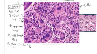 Neoplasia:  Grading and Staging