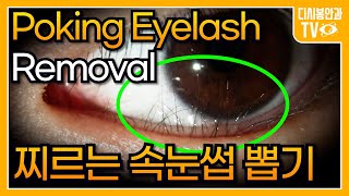 Poking Eyelashes Removal.