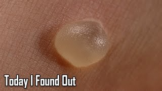 What Causes Blisters