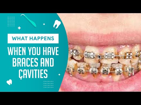 Can you get cavities under braces?
