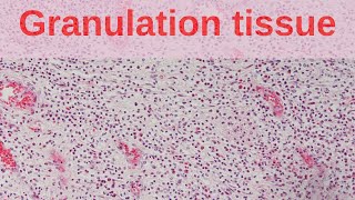 What is Granulation Tissue? - Pathology mini tutorial