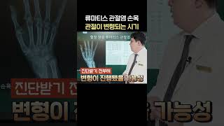 류마티스 관절염 손목 연골이 닳아 변형이 되는 기간?