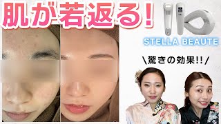 【ニキビが消えた！】脱毛して美肌に！ステラボーテ脱毛器