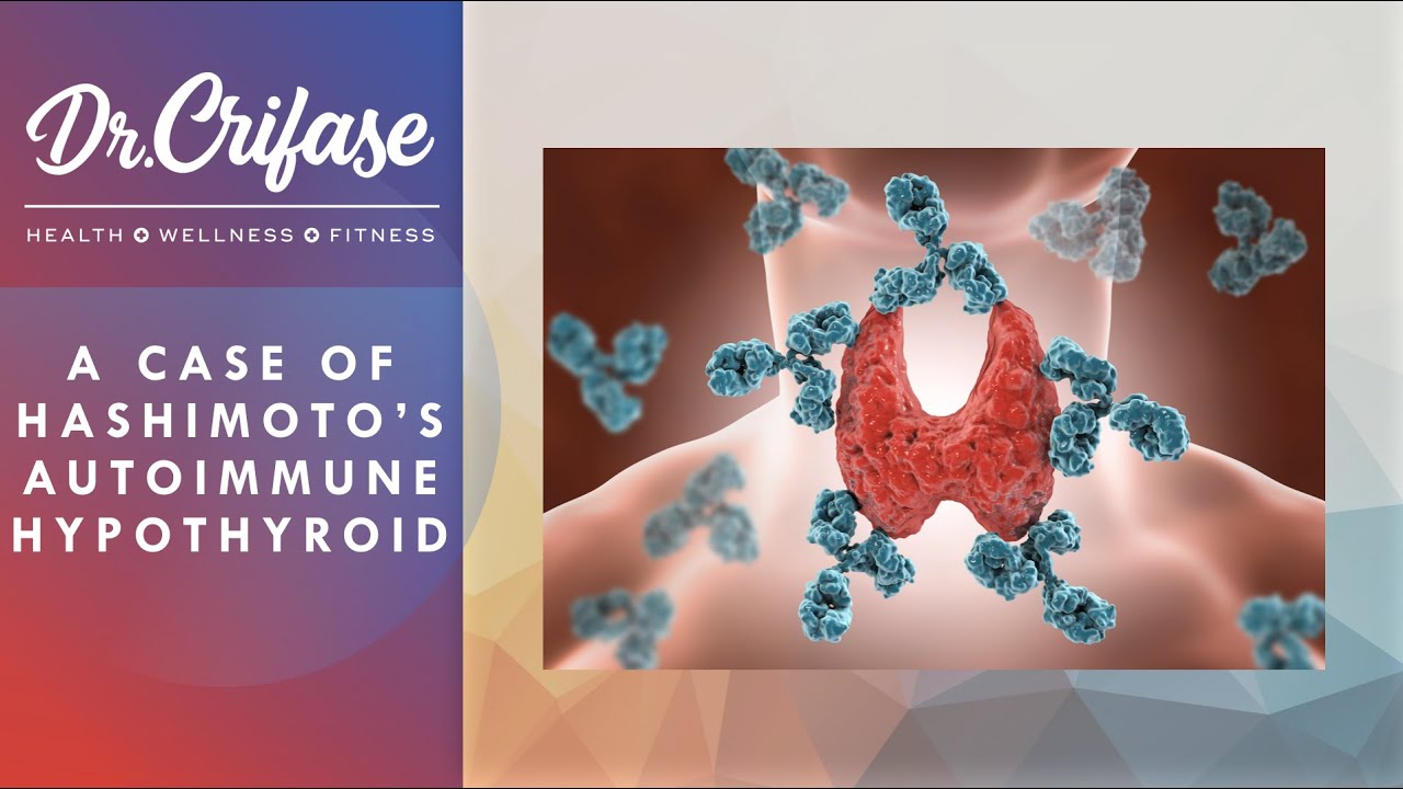Masterclass Hashimoto S Thyroid Case Study Youtube