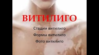 Витилиго. Витилиго признаки. Витилиго фото.