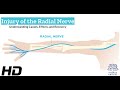 Radial Nerve Injury: What You Need to Know