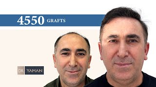 4550 Grafts Hair Transplant Before After Result | Dr Resul Yaman