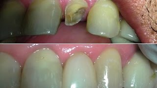 A 59 months followup of flowable composite resin restored broken lateral incisor with glass fiber ro