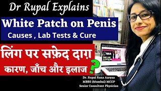 White Patch on Penis I Causes I Treatment I लिंग पर सफ़ेद दाग़ I कारण, जाँच और इलाज I Dr Rupal