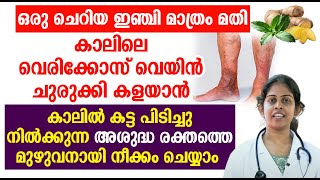 ഒരു ചെറിയ ഇഞ്ചി മാത്രം അതി കാലിലെ വെരിക്കോസ് വെയിൻ ചുരുക്കി കളയാൻ | Varicose veins Malayalam