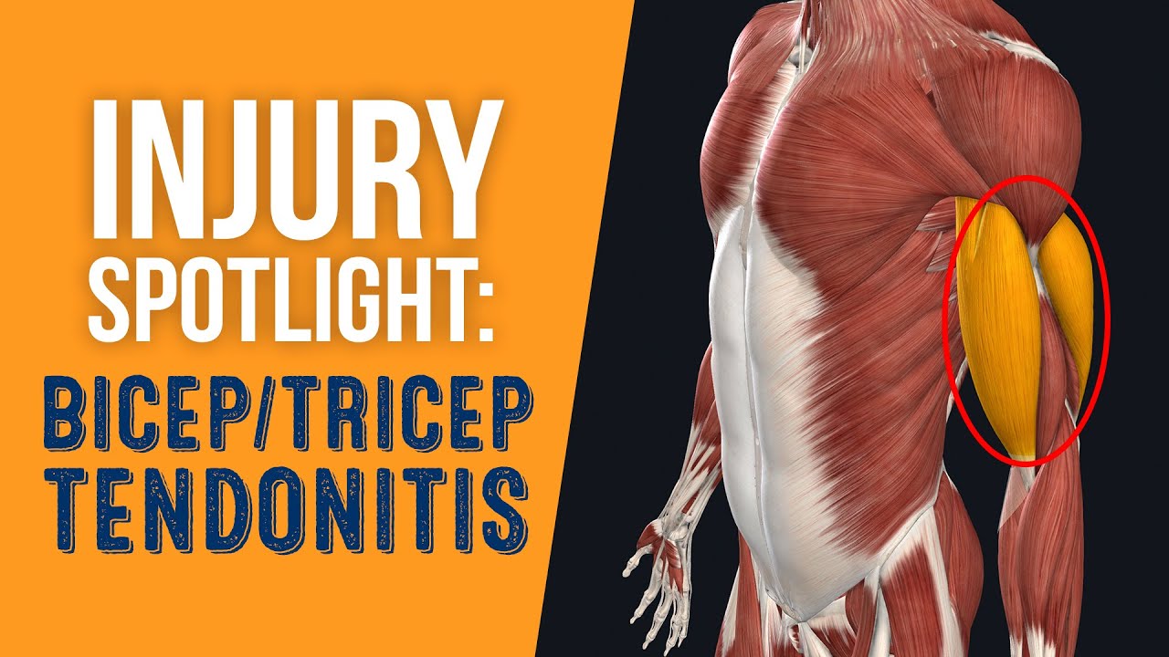 Injury Spotlight: Bicep & Tricep Tendonitis - YouTube