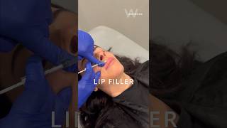 Before \u0026 After: Restylane Kysse Lip Filler