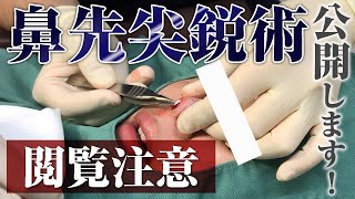 【閲覧注意】鼻先尖鋭術【施術動画】