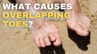 Overlapping Toes: Causes and Solutions