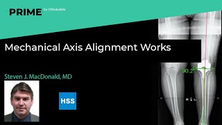 Mechanical Axis Alignment Works - Steven MacDonald MD
